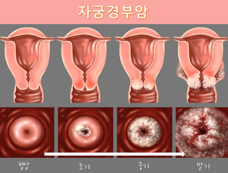 자궁경부암 진행단계