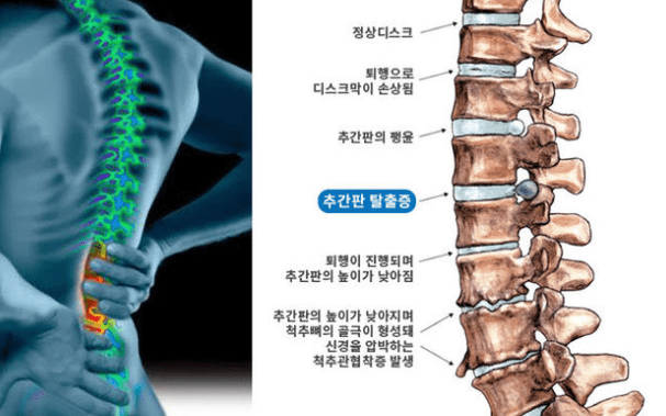 허리디스크 설명 사진