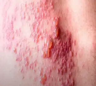 대상포진 사진