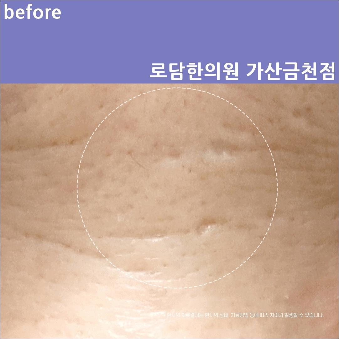  광명 여드름 흉터 제거 한의원 치료 과정 새살침 코라테라피