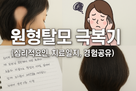 원형탈모 극복기 (심리적 요인, 치료일지, 경험공유)