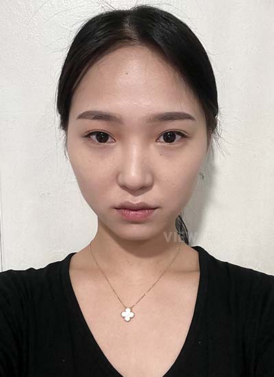 Before plastic surgery in Korea