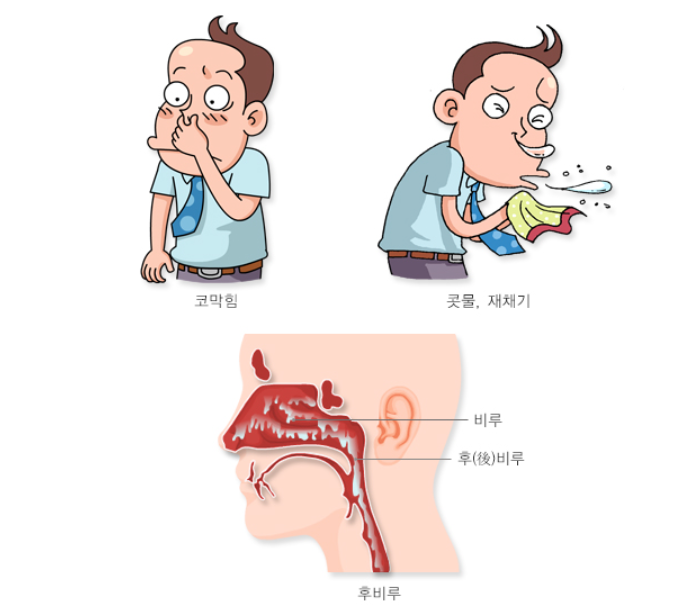 비염의 증상