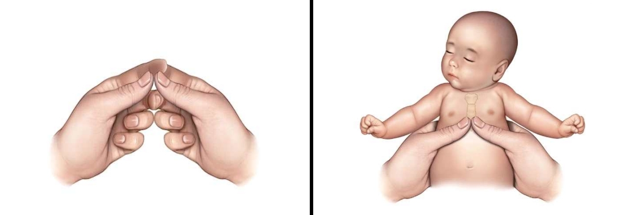 영아 심폐소생술