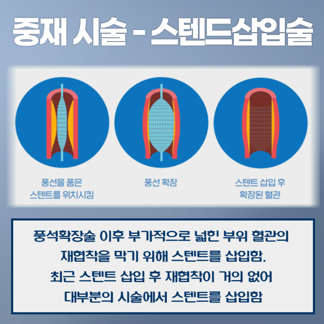 스텐트삽입술