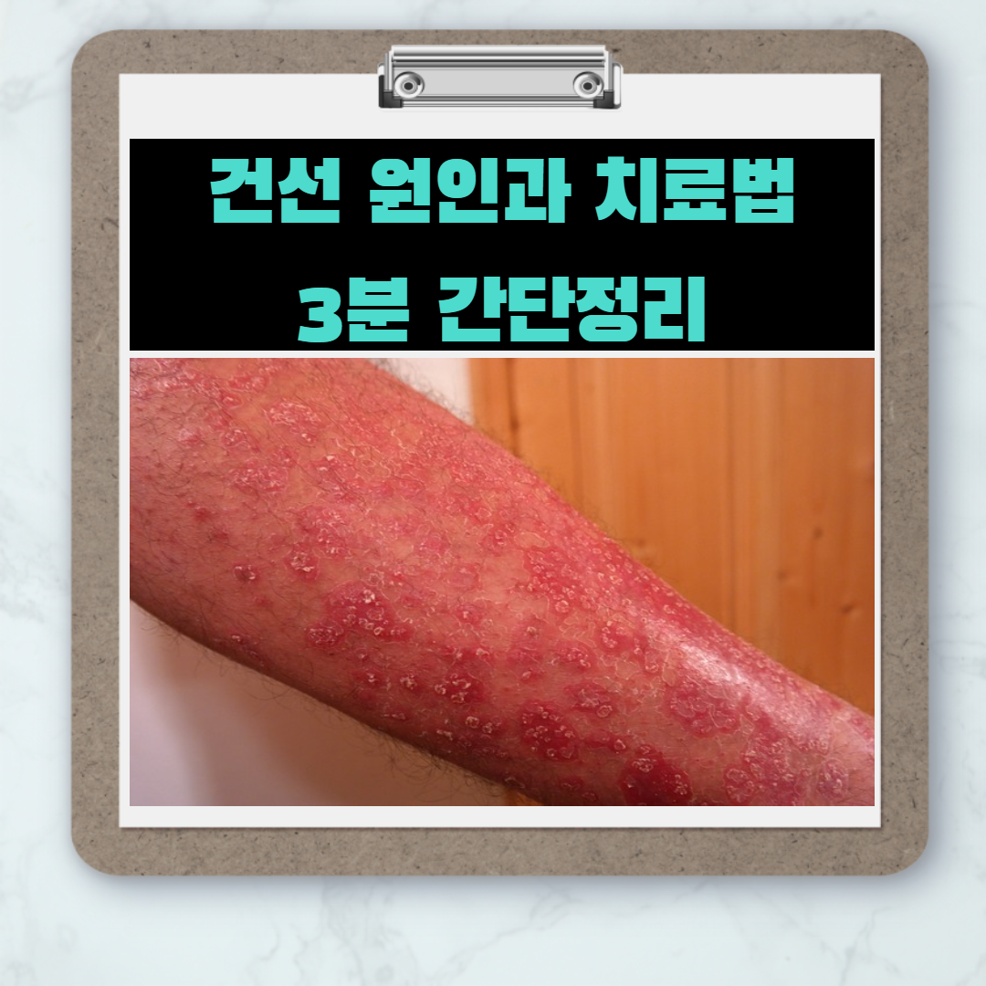  건선 원인과 치료법 3분 간단정리