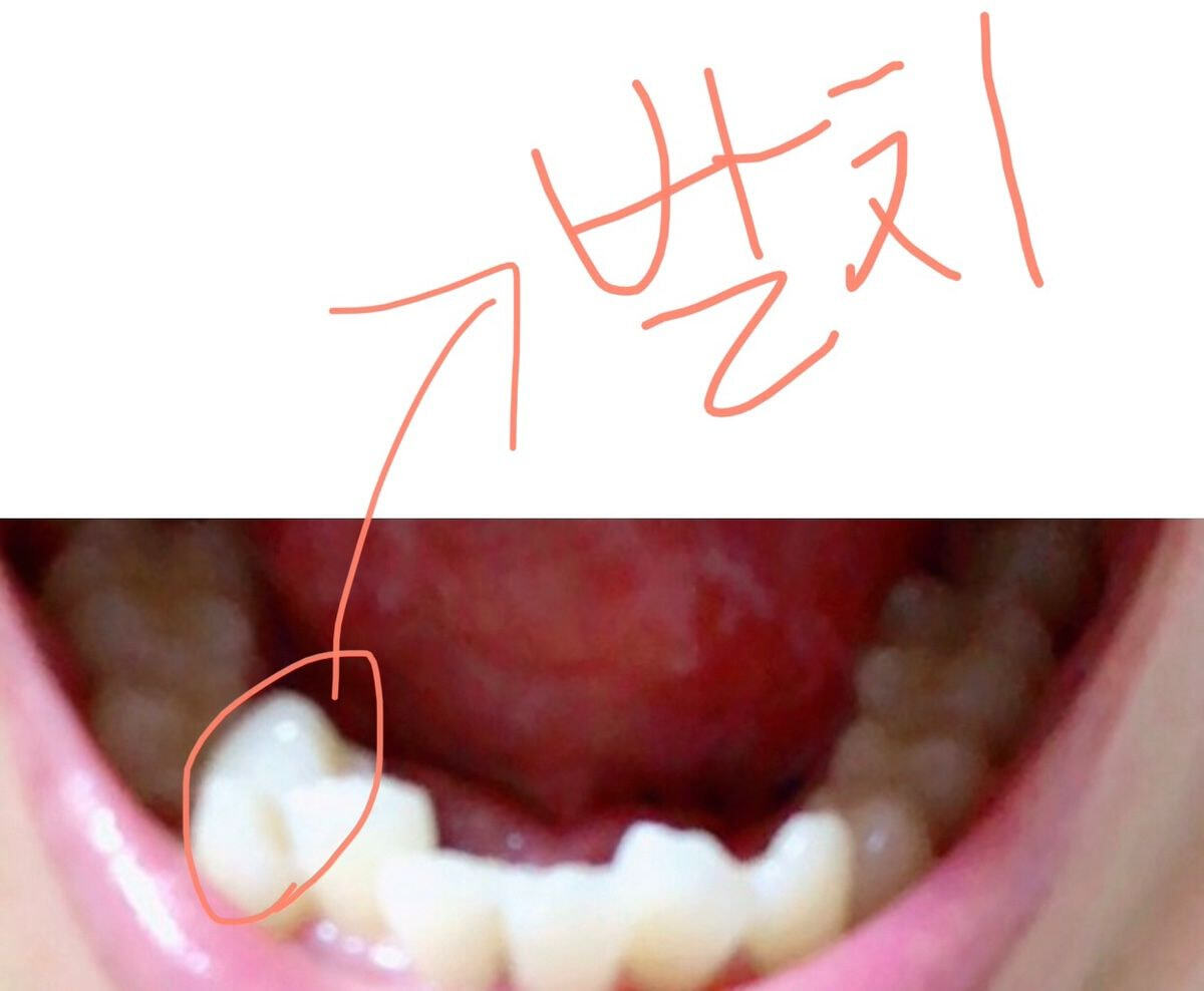 발치한 치아