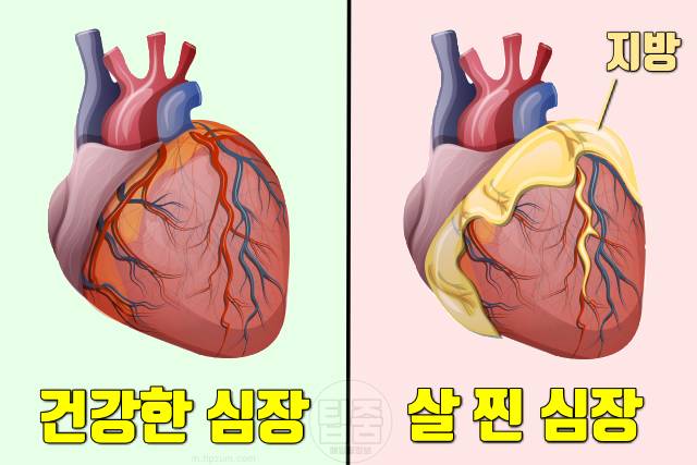 심장이 불규칙하게 뛰는 이유 심방세동을 유발 부정맥 비만을 유발