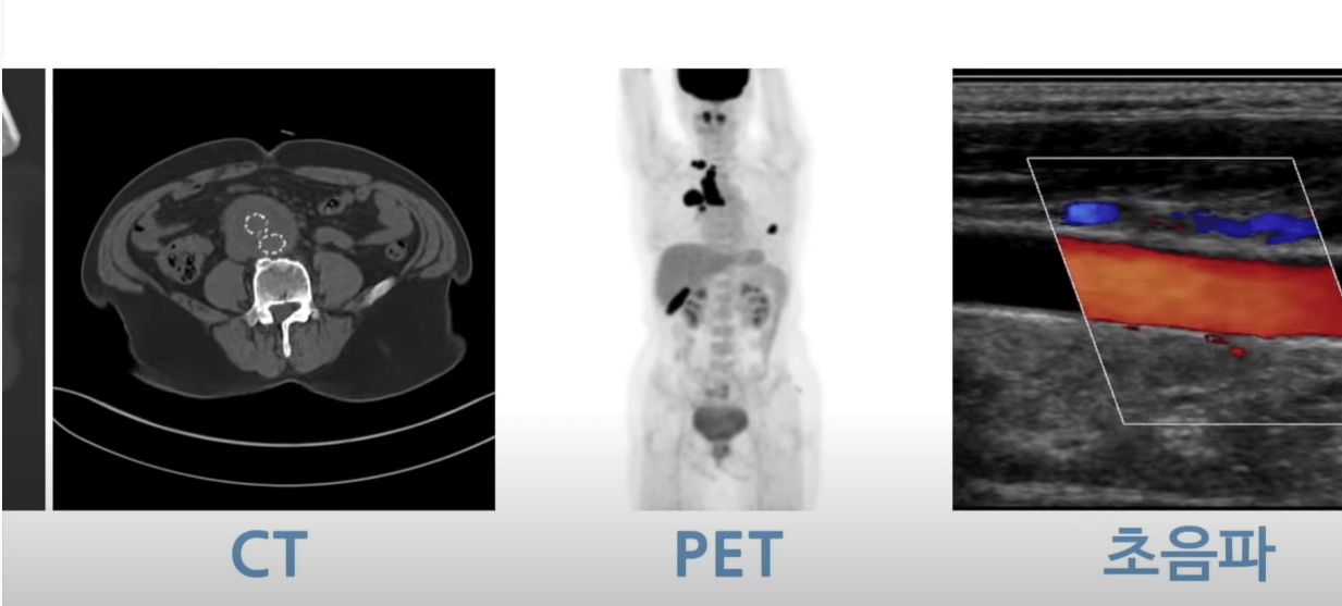 CT-PET-초음파사진