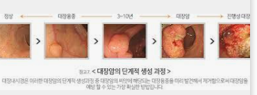  대장암 초기증상 과 검사방법  ( 원인 8가지 )