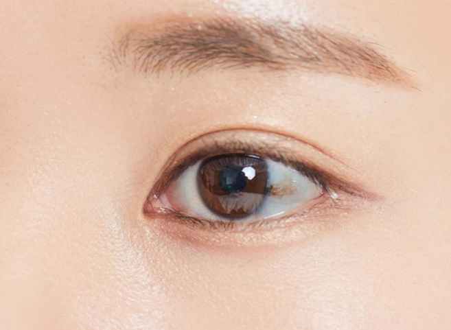 결막모반 제거 수술 및 수술 비용 (+ 원인 실비 보험)