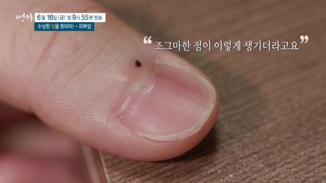 명의 수상한 &#39;점&#39;을 찾아라&#44; 피부암&#44; 악성 흑색종&#44; 예방&#44; 치료 방법