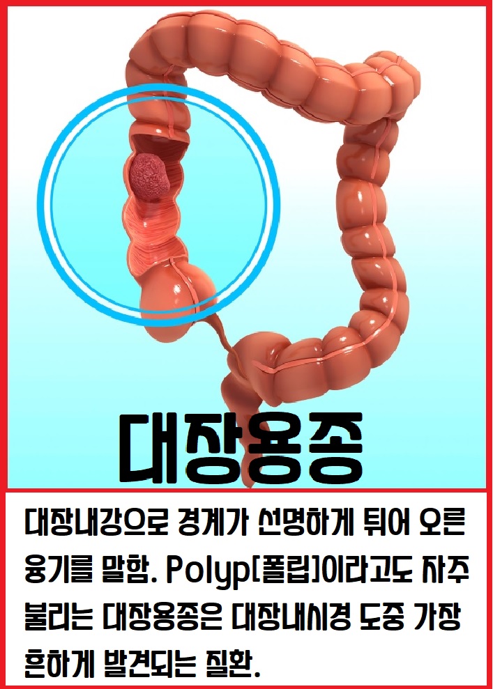 대장용종
