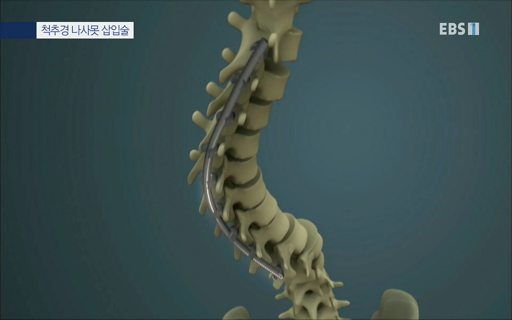 EBS 명의 헬스케어 - TV - 교육의 중심 EBS명의 15년 - 허리통증을 잡아라!.mp4_20220805_210254.526.jpg
