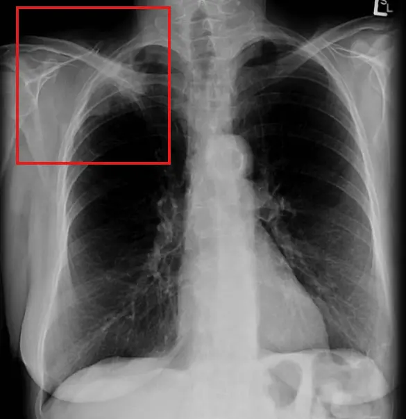 large cell carcinoma