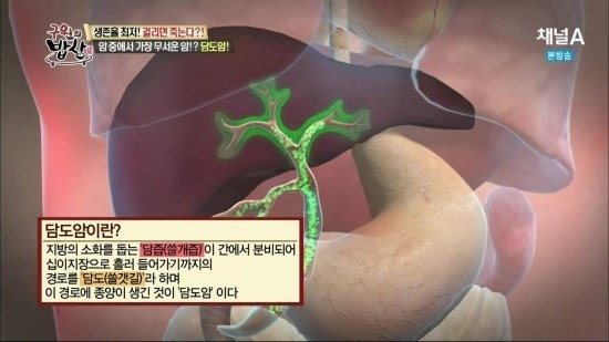 담도암 설명 이미지