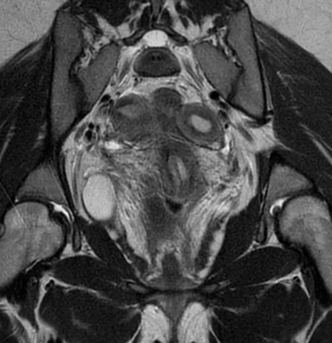 쌍각자궁의 MRI