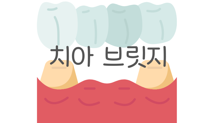 치아 브릿지 종류 및 가격