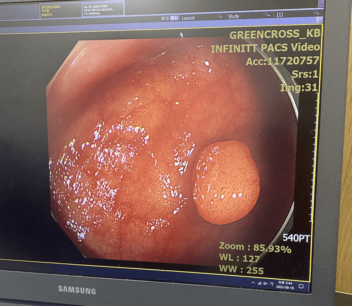 대장내시경 용종제거