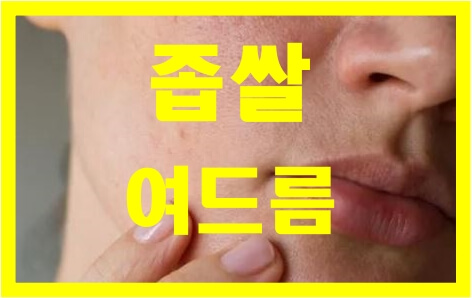  좁쌀 여드름 없애는 법 알아보기 꿀팁 !