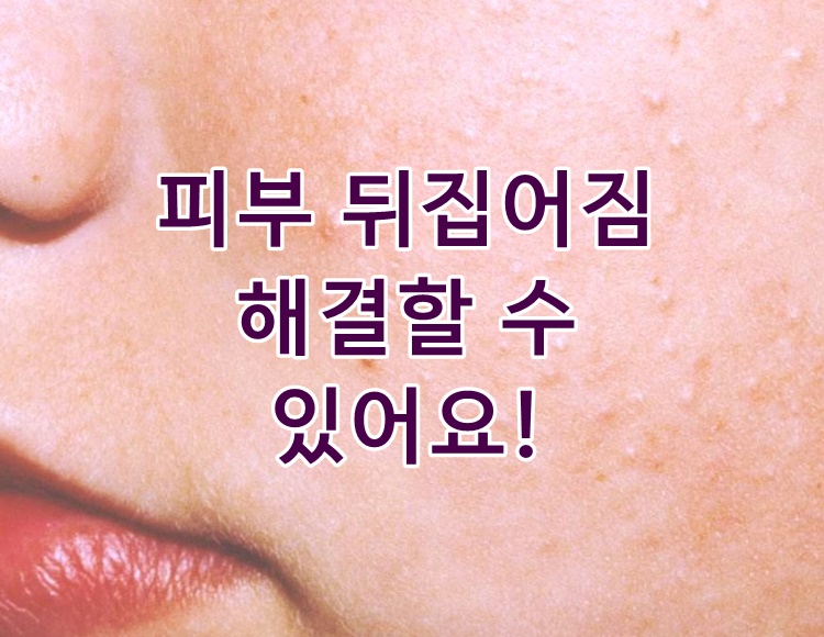  피부 뒤집어짐 해결방법 노하우 N가지