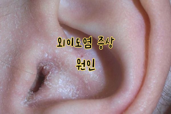 여름철 외이도염 증상 원인