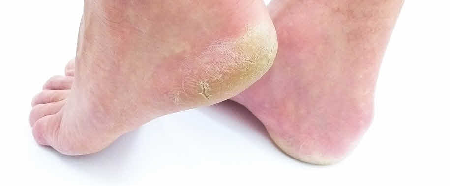  발바닥 껍질이 벗겨지는 이유 6가지