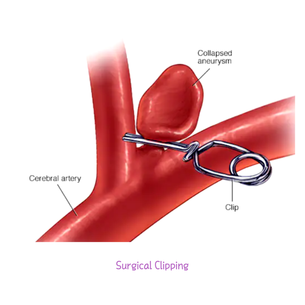 뇌동맥류 클립결찰수술 Surgical Clipping