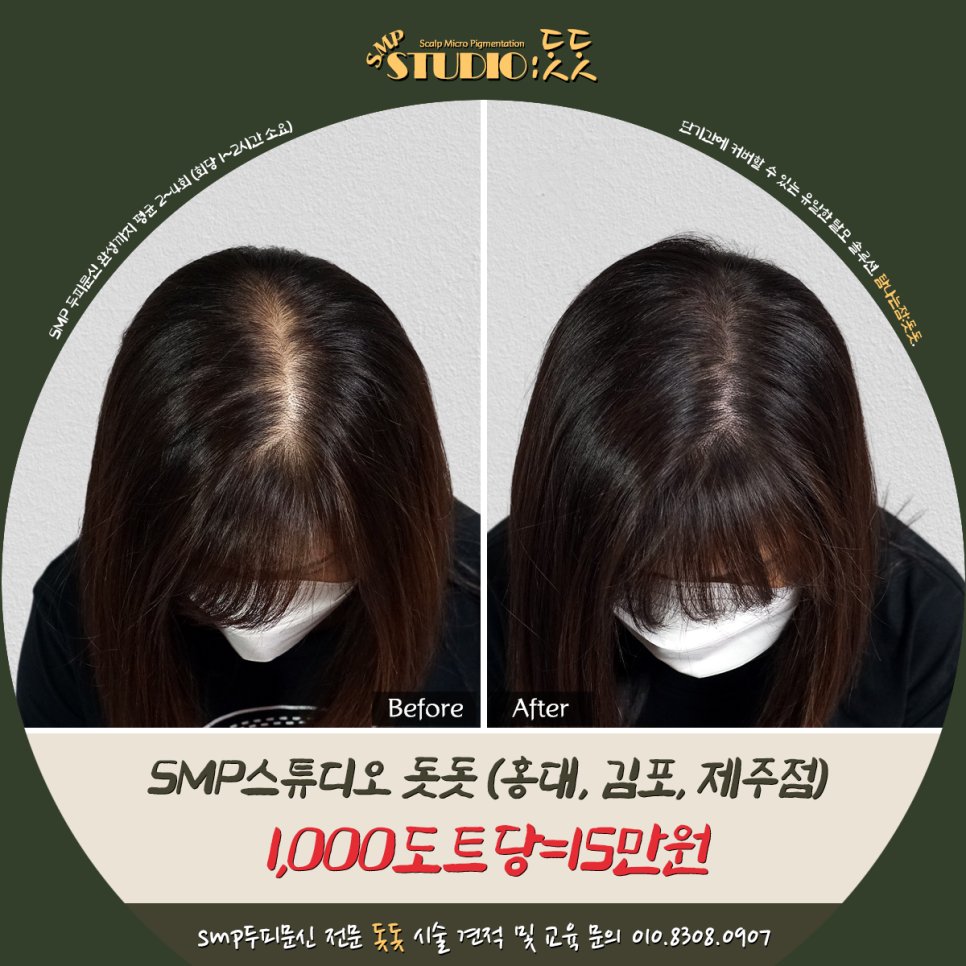  여성 정수리 탈모 치료 두피문신 해결법