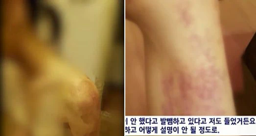  원주 유흥업소 종업원 감금 폭행 피해자들이 업주의 가혹행위 직후 촬영해둔 몸 상태 사람을 이렇게 만들어놔 2평 방에 갇힌 종업원 5명 온몸에 남은 흔적들 자매 유흥업소 업주 구속