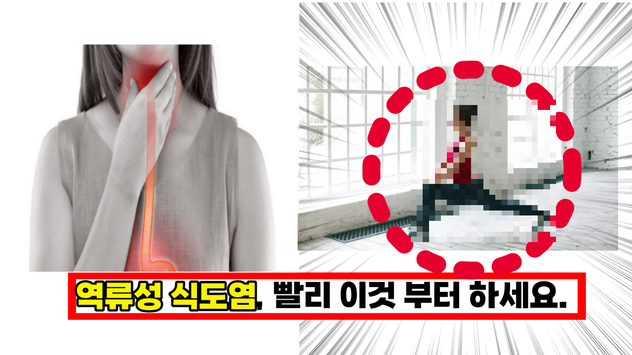  역류성 식도염, 빨리 이것 부터 하세요. 잘못하면 큰병 됩니다.