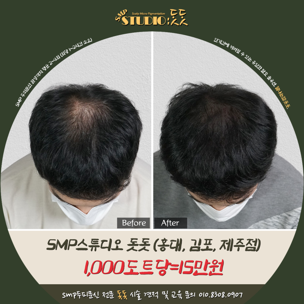  smp 두피문신 비용 천도트당 15만원