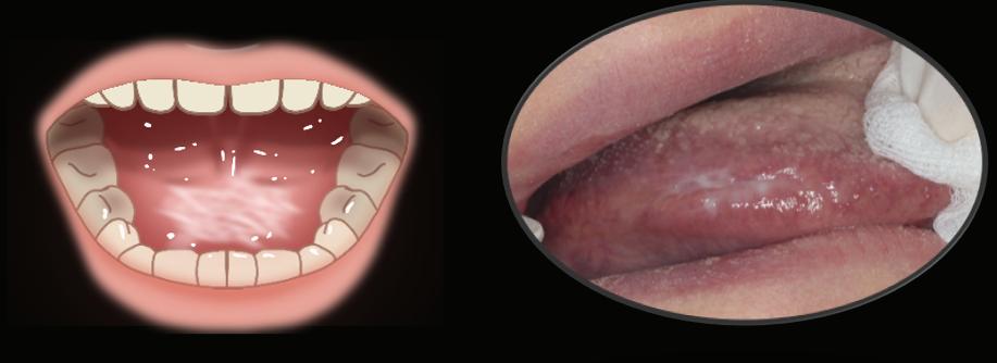 구강 편평 태선 사진과 치료, 원인까지 구강내과의사가 분석