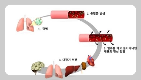 패혈증 감염사진