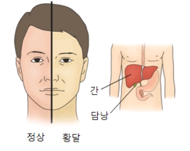 담도암