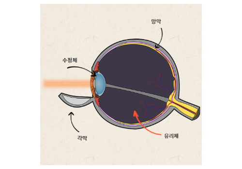 비문증