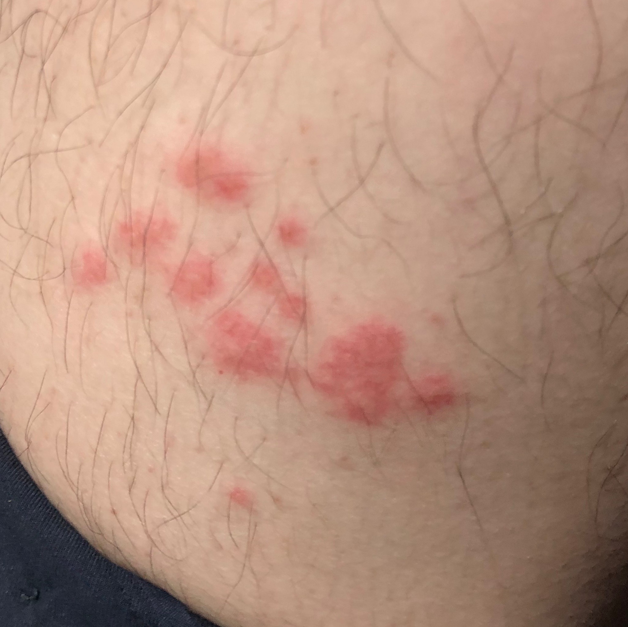 대상포진 회복을 위한 영양 : 올바른 음식 섭취 가이드