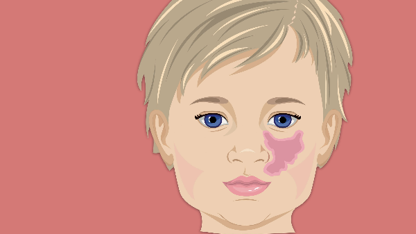  화염상모반(Nevus Flammeus) 정의, 원인, 증상, 진단, 치료