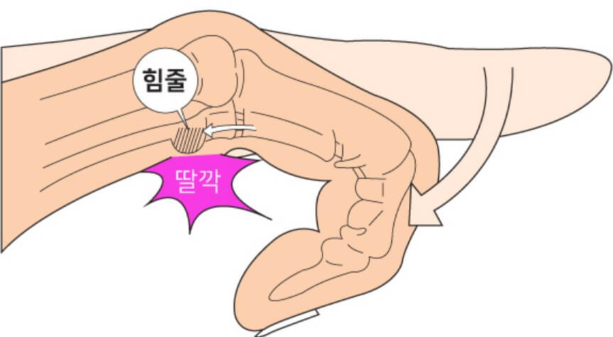  방아쇠 수지 증후군 증상 4가지 및 원인,마사지 방법