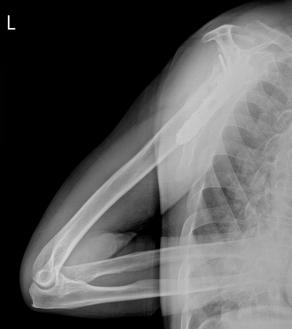 Humerus Lateral modify 검사