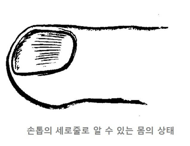  손톱 세로줄 손톱 검은세로줄이 생기는 원인