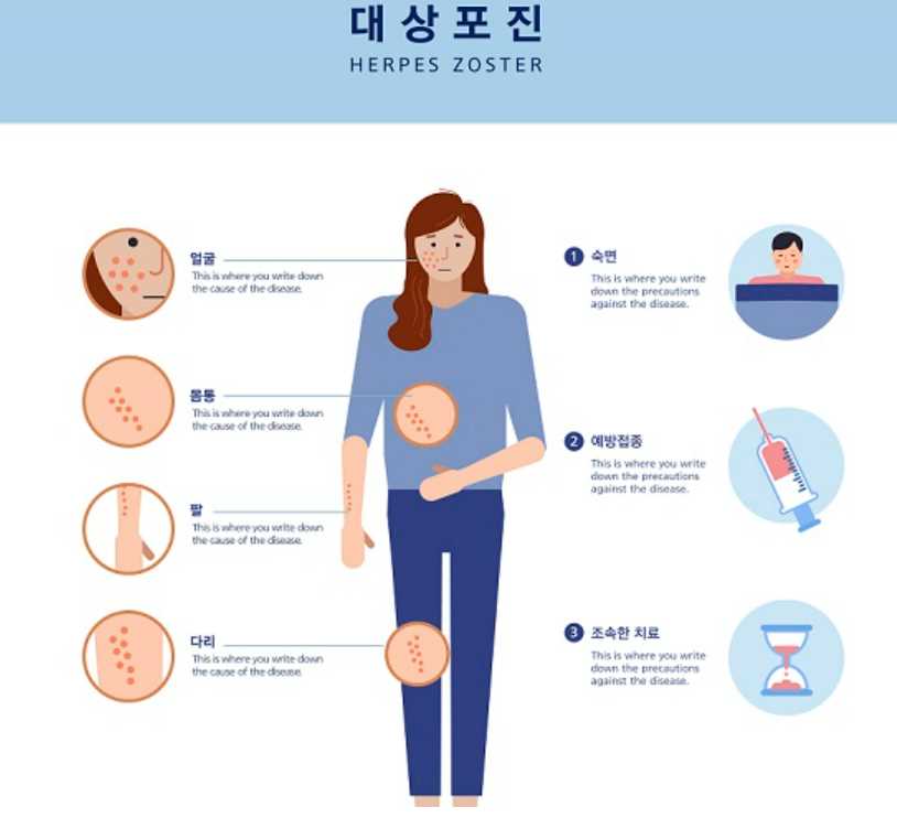 대상포진 발생 부위