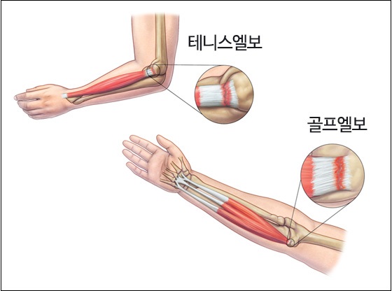 손목 쓰는데 왜 팔꿈치가 아프지?...통증 환자 급증