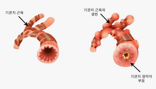 천식 증상