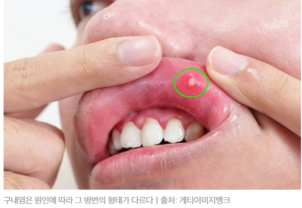  피로 때문에 생기는 입술 물집 '헤르페스성 구내염' 빨리 낫는 법