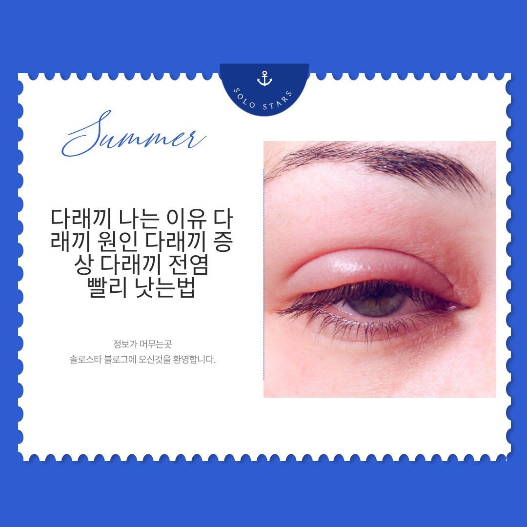 눈다래끼 사진