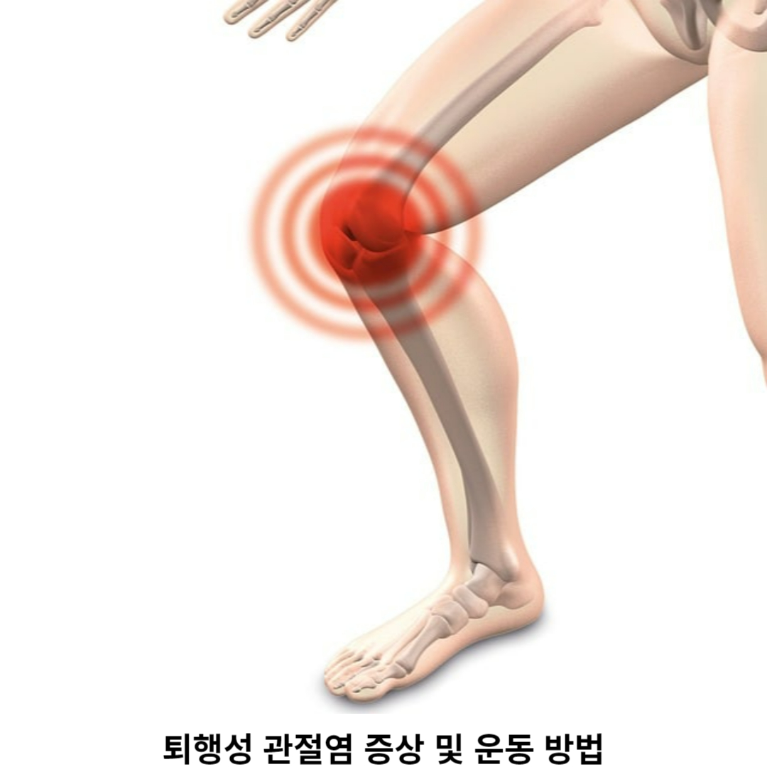 퇴행성 관절염의 정의