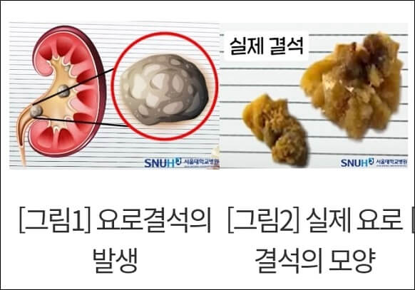 왼쪽 아랫배 통증 원인과 치료법