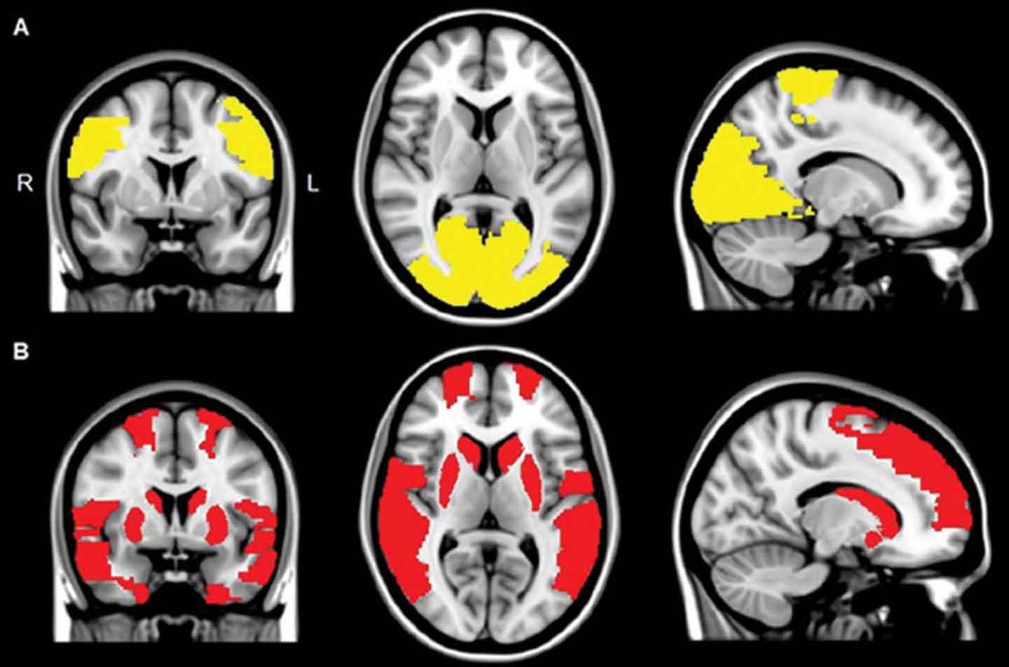 Hallucination symptoms in patients with Parkinson&#39;s disease 2