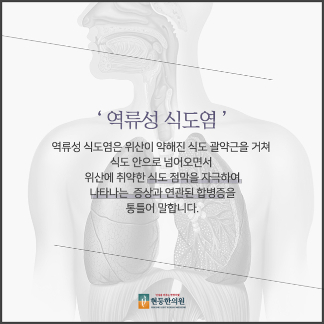 원인과 치료방법 역류성 식도염 흉통